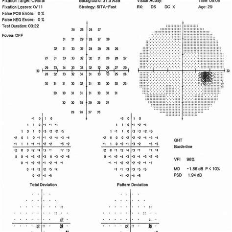 blind spot test normal results|Blind Spot in Eye: Vision, Test, One Eye, Human Eye, .